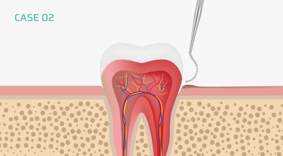 치근활택술 / 치주소파술